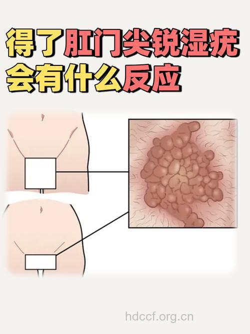 性接触感染HPV可导致肛门癌