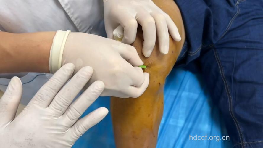 膝关节骨质增生的手术疗法