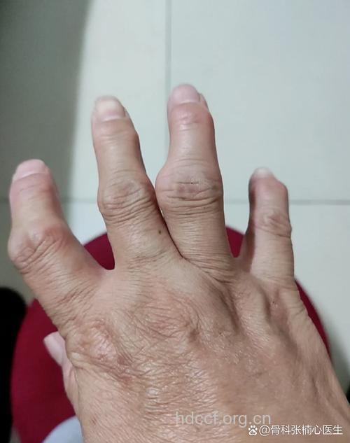 主要的骨质增生的症状表现