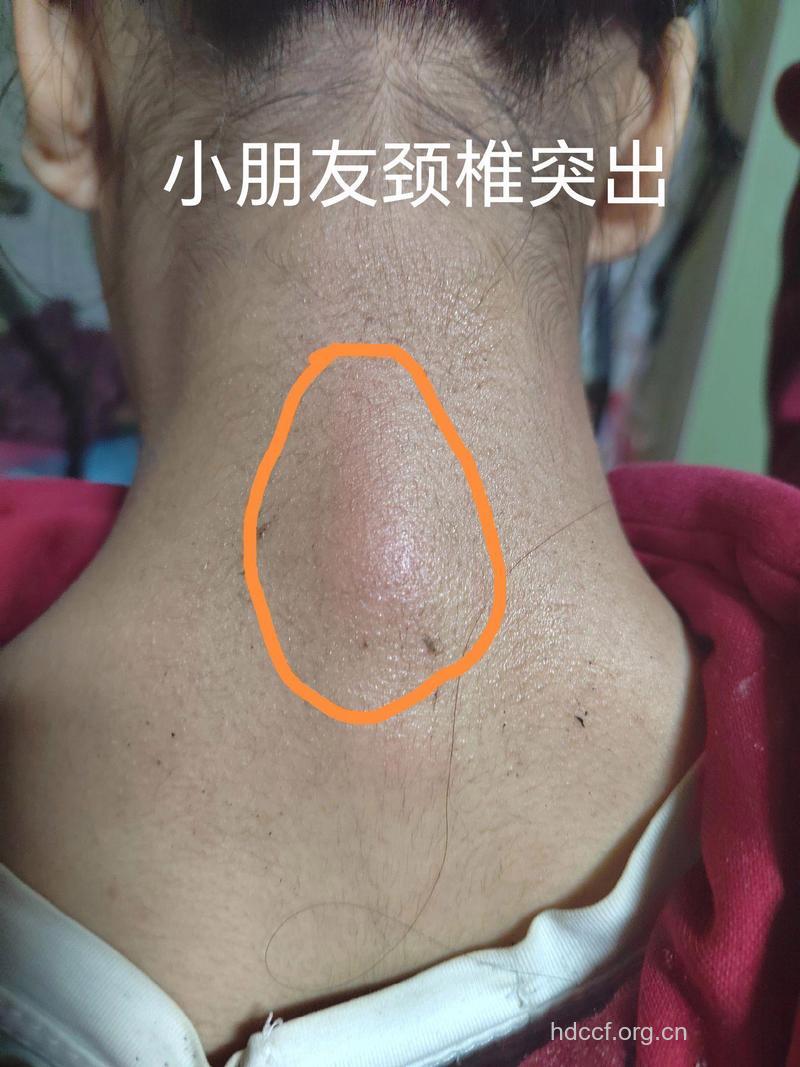 颈椎骨质增生有哪些症状
