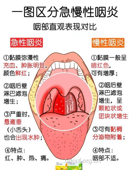 急性咽炎和慢性咽炎的区别