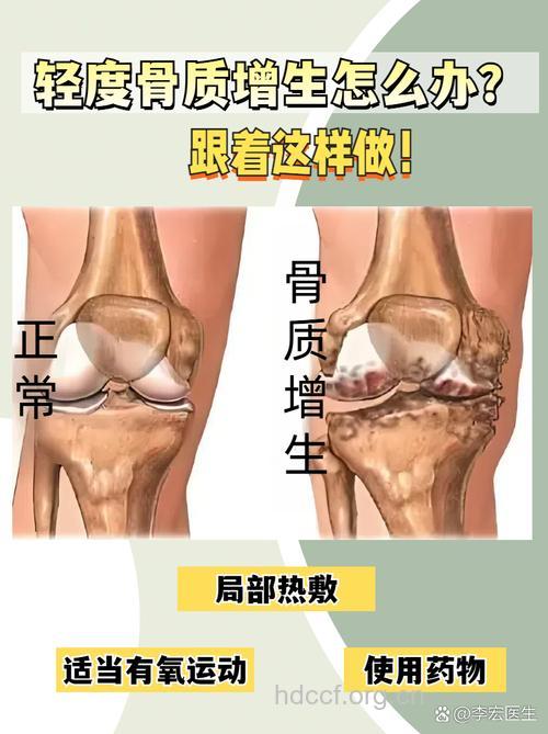 膝关节容骨质增生的原因是什么