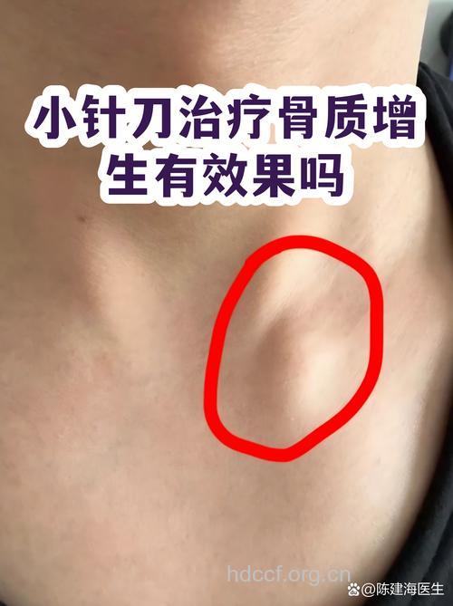 骨质增生手术治疗效果好吗?