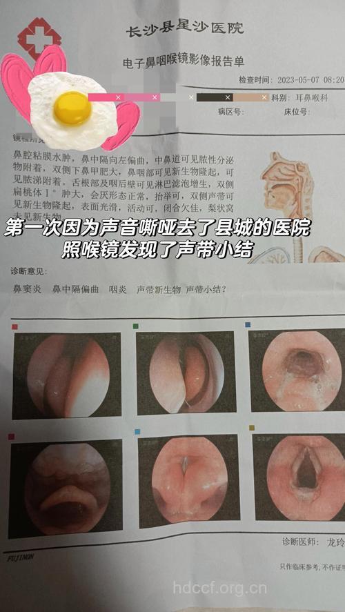 教师长期用嗓当心声带息肉