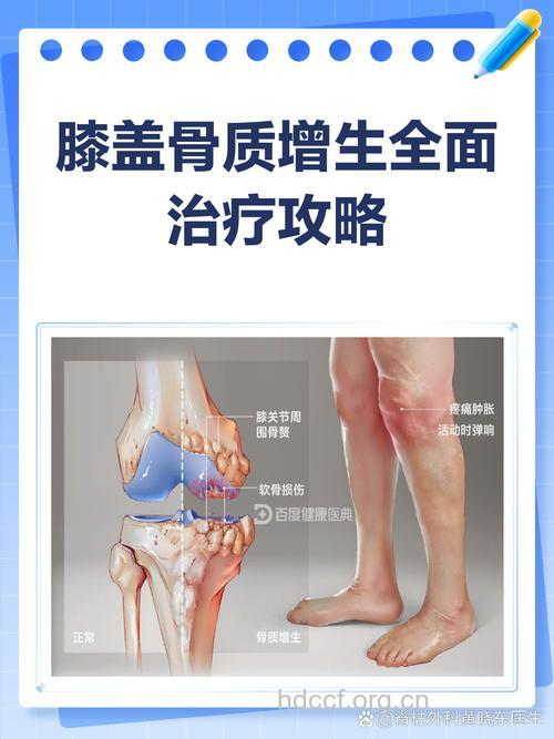 骨质增生如何产生的呢
