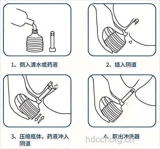 女性阴道肿瘤怎么进行冲洗护理