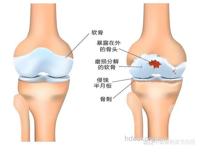 膝关节骨质增生你懂多少？