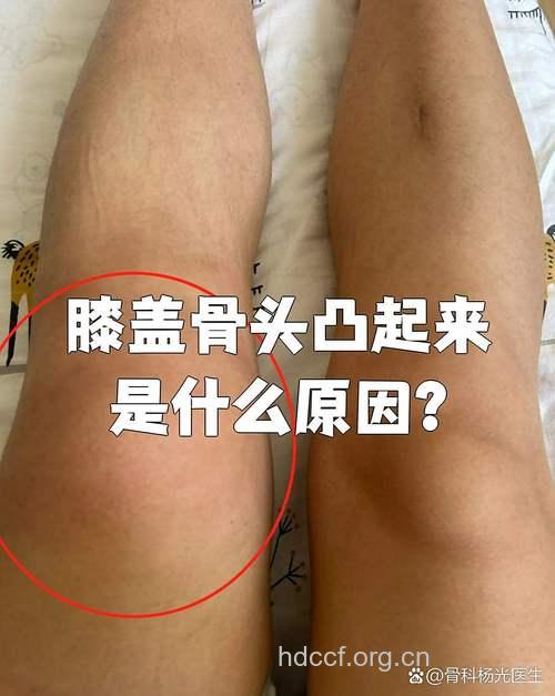 膝盖骨质增生有哪些常见症状？