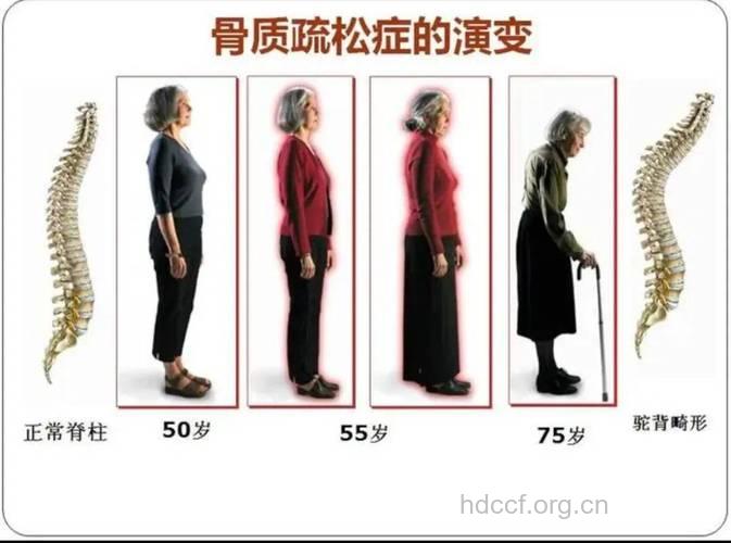 骨质增生易发的人群有哪些?