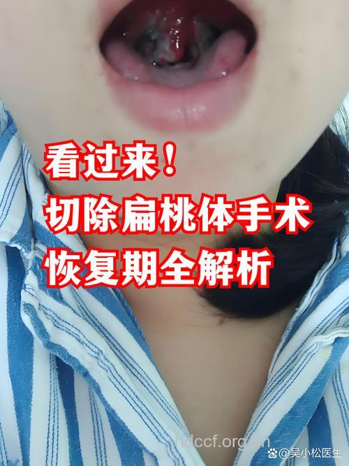 什么情况下要切除扁桃体