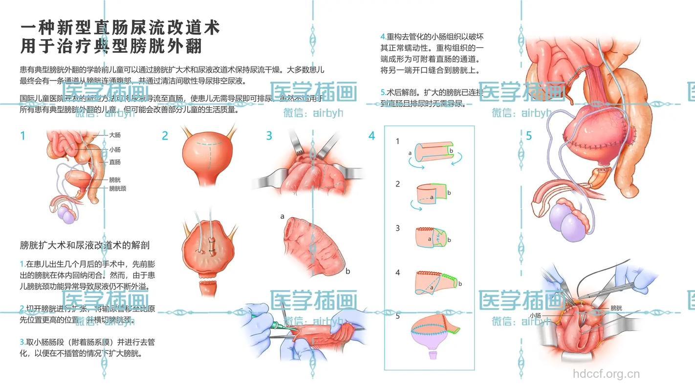 膀胱切除术与性生活