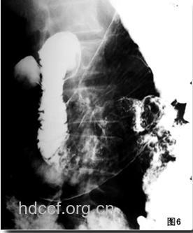 胃溃疡有哪些影像表现？