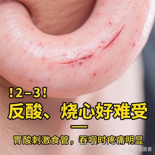 水喝多了,胃溃疡药会失效