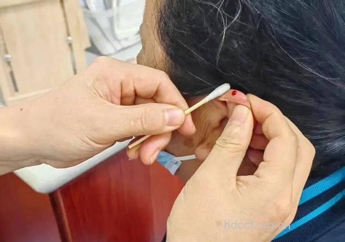 中医按摩耳穴治疗梅核气