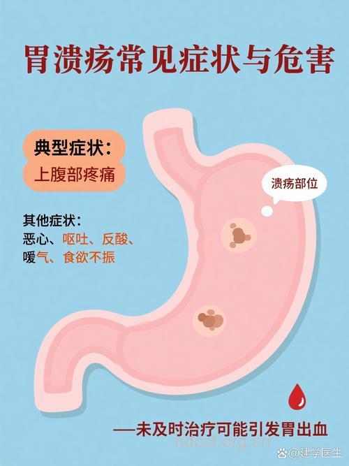 胃溃疡的四个信号