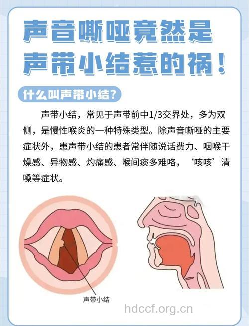 什么是声带小结