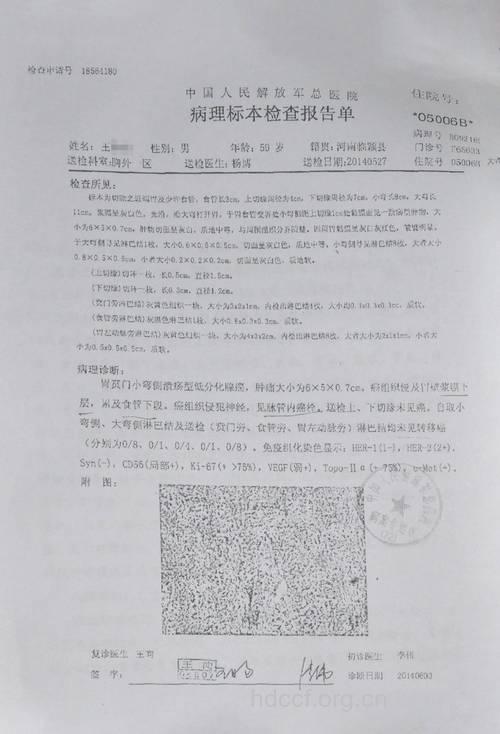 抗癌成功病例有哪些