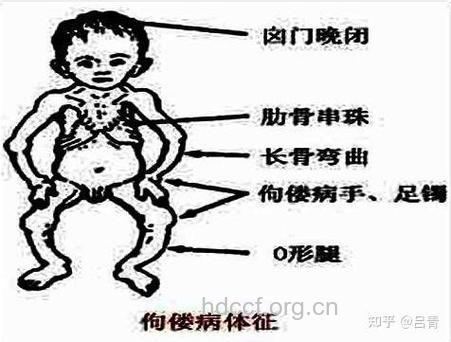 不同时期佝偻病如何辩证治疗