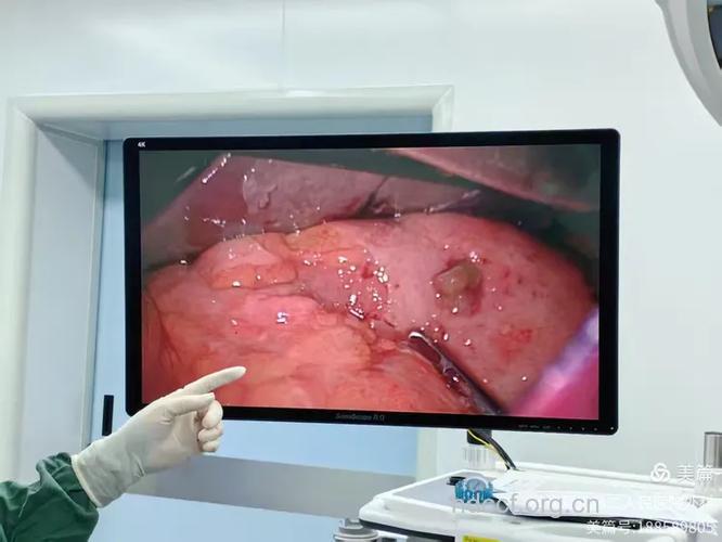 胃溃疡穿孔，大抢救