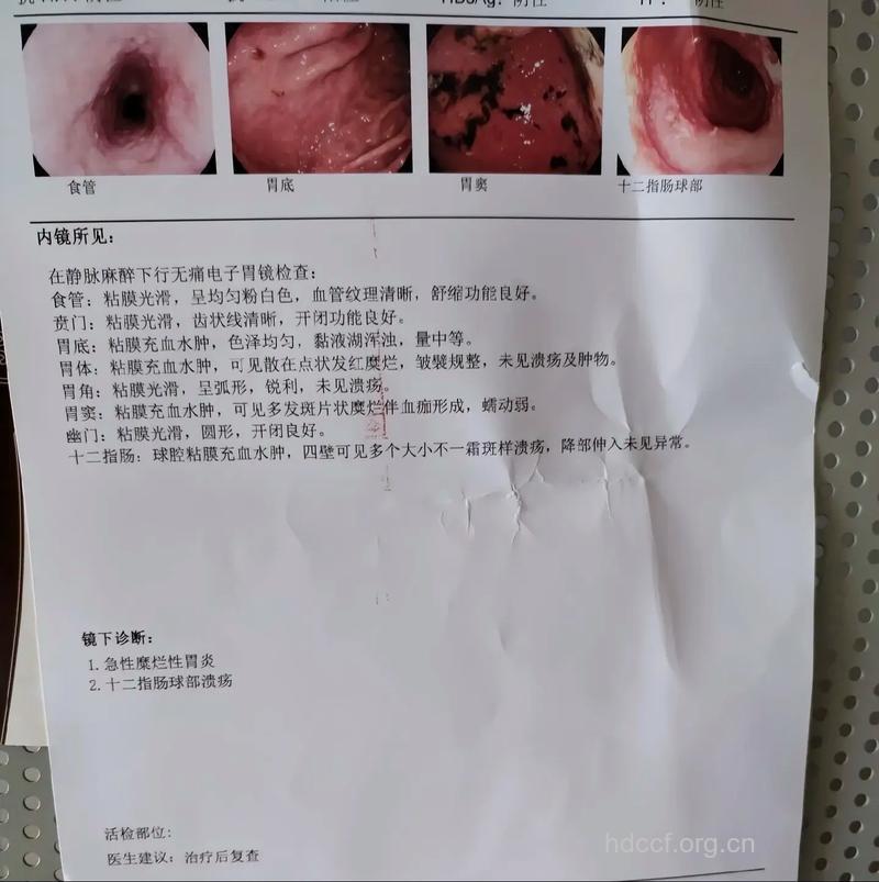 网友自述：两次胃出血经历