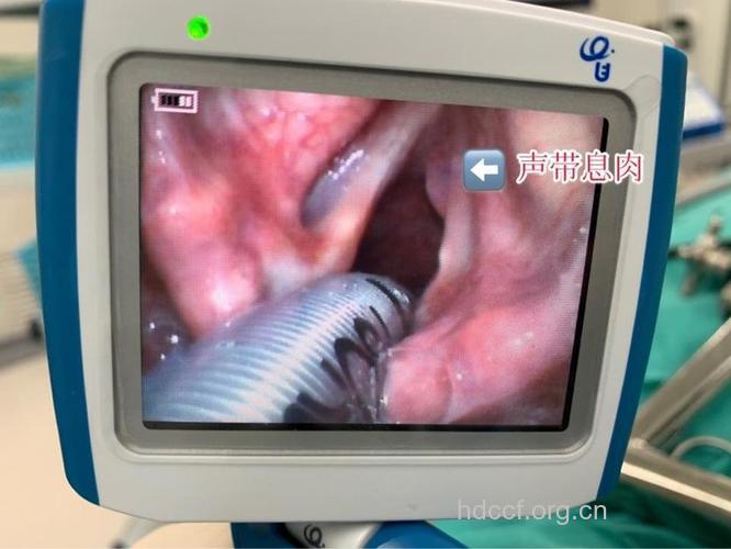 手术摘除可治疗声带息肉