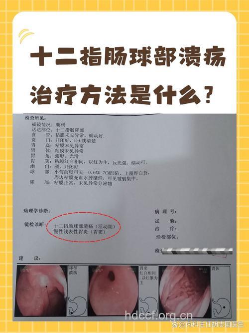 十二指肠溃疡如何治疗