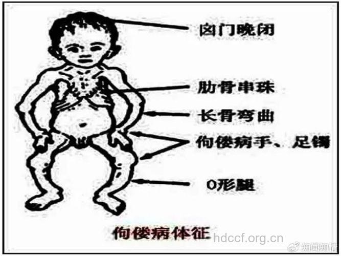 什么是维生素D缺乏性佝偻病