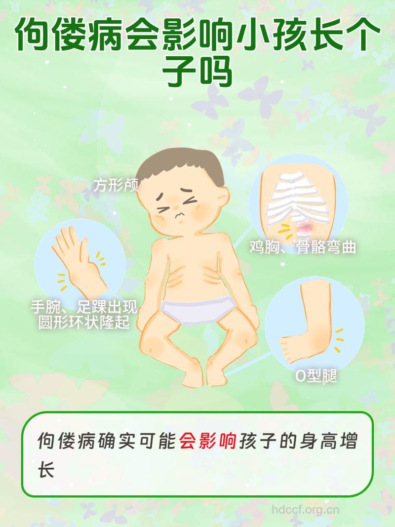 佝偻病有什么治疗误区