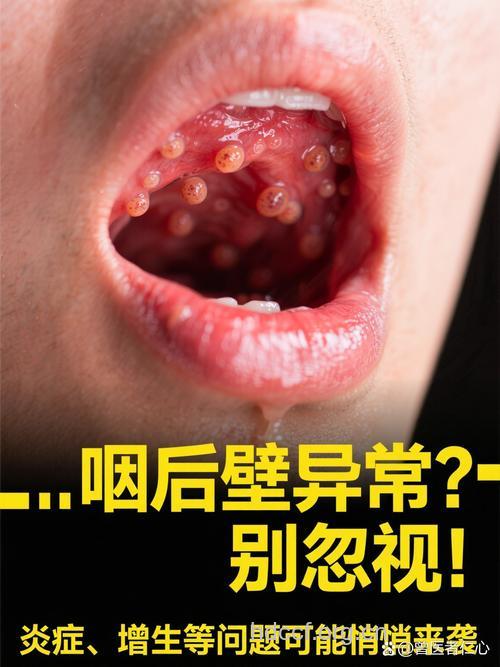 慢性咽炎背后隐藏的秘密