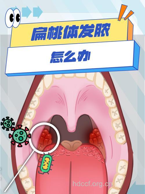 警惕:扁桃腺炎可变成大脓肿