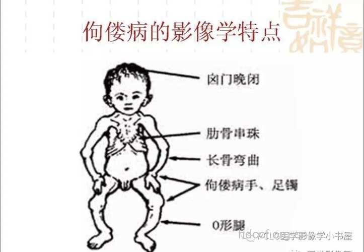 常出现的佝偻病的症状是什么