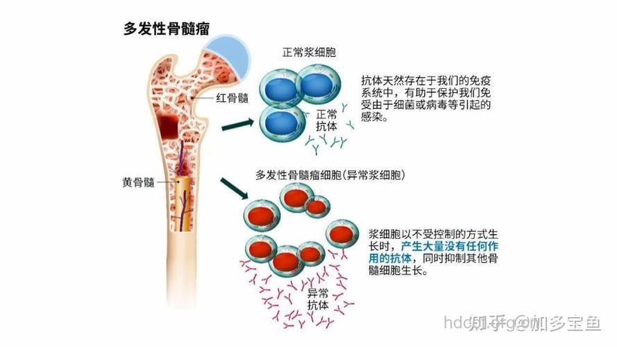 中老年人如何面对多发性骨髓瘤?