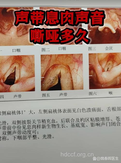 声带息肉早期有哪些症状