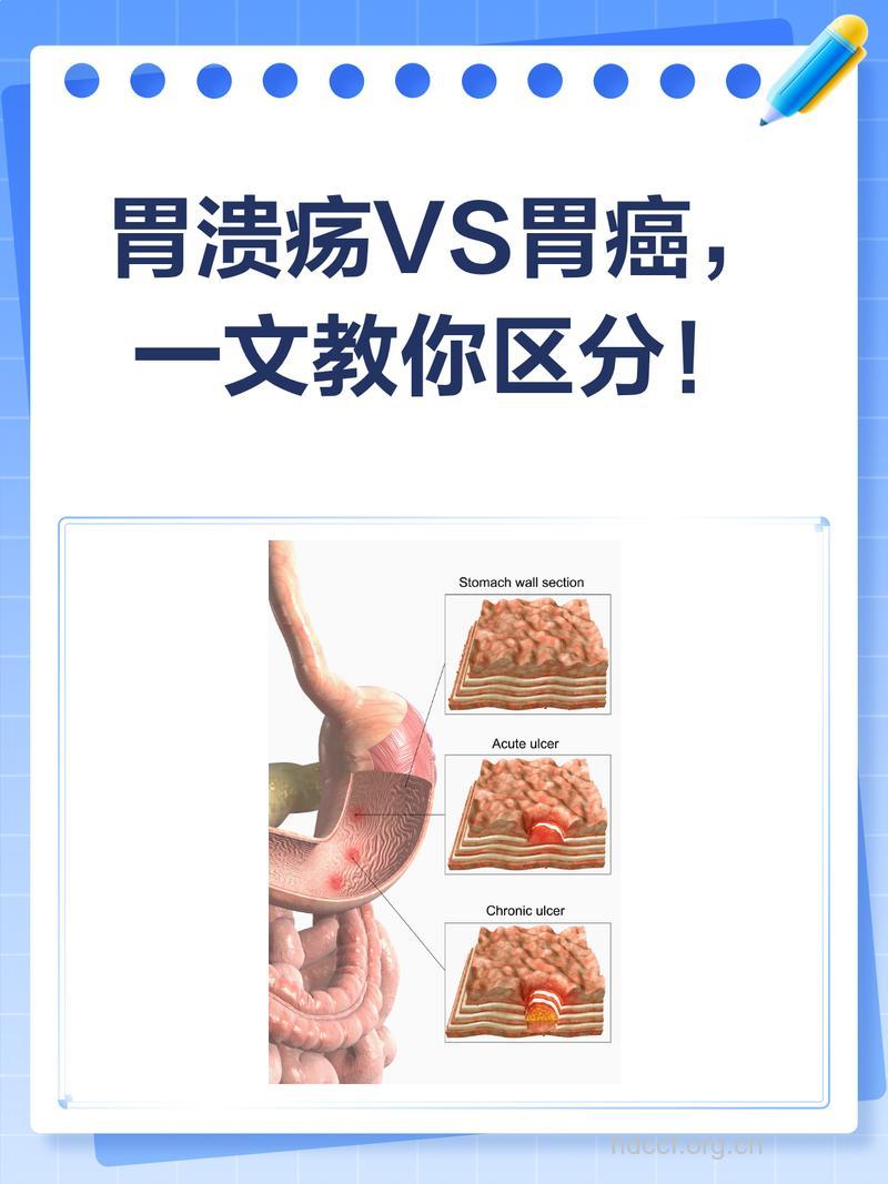 胃溃疡与胃癌一步之遥！