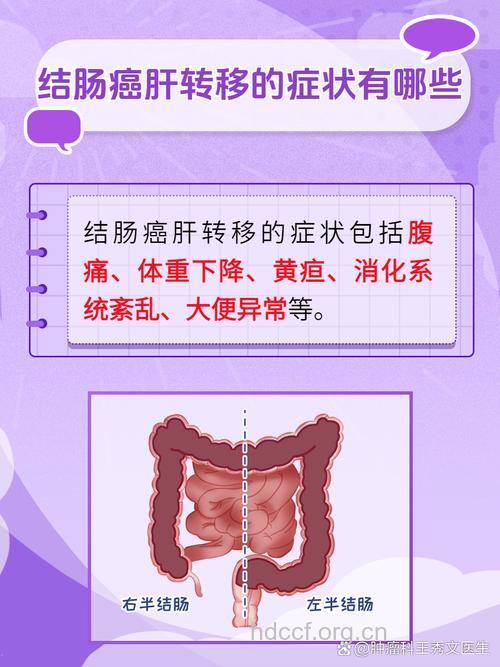 惊!有五成肠癌会出现肝转移
