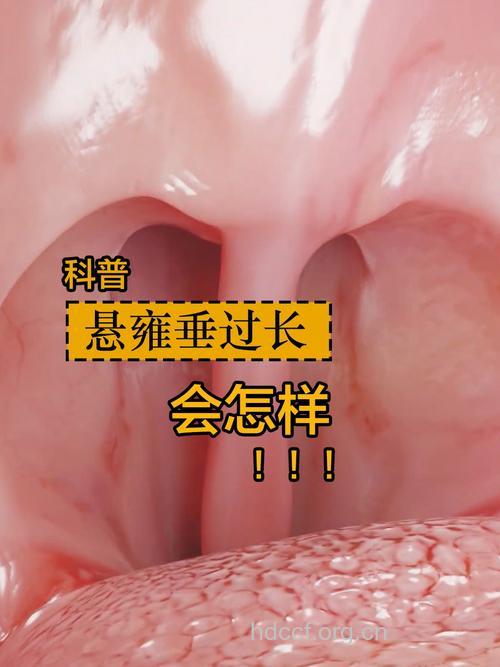为什么会导致悬雍垂过长