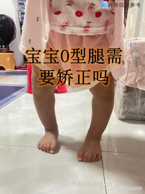 2岁前宝宝O形腿无需治疗