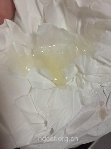 男性死精症的精子是什么颜色