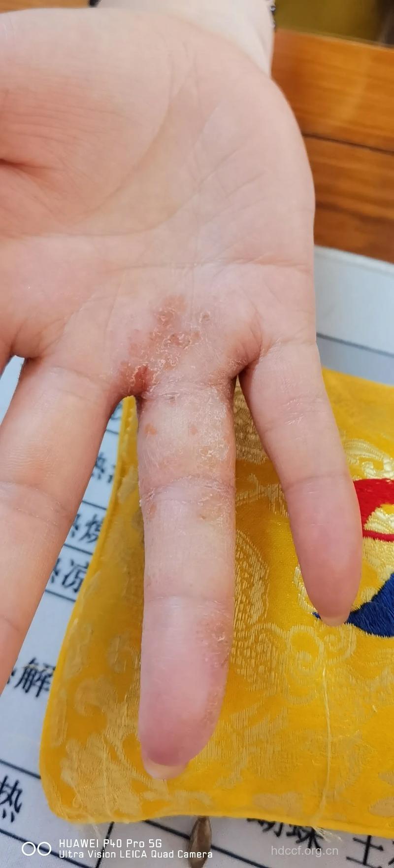 玩麻将可能玩出溃疡病