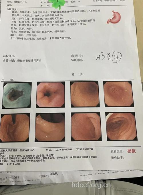 无痛胃镜　多好啊！