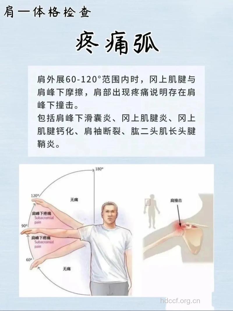 肩周炎的早期症状及检查项目