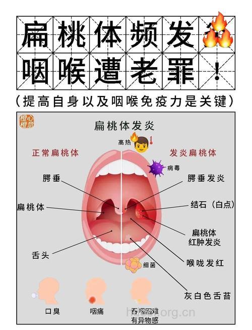 如何应对扁桃体发炎并发症方法