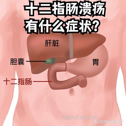 十二指肠溃疡的疼痛表现