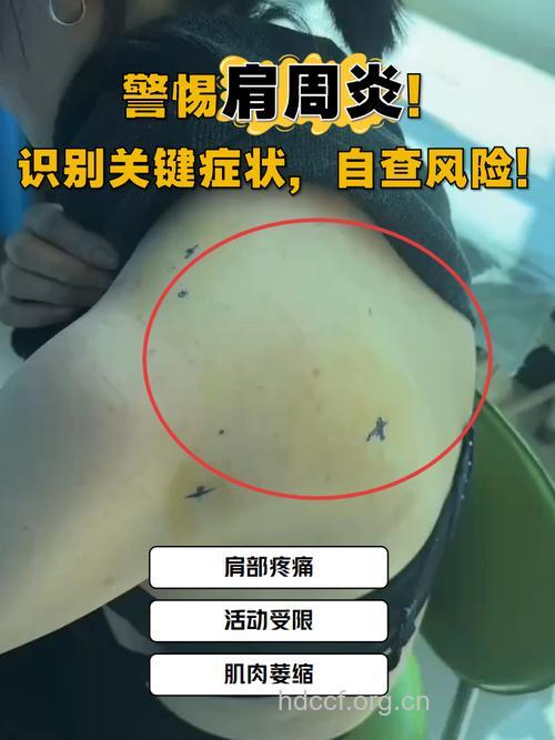 肩周炎患者的症状是什么