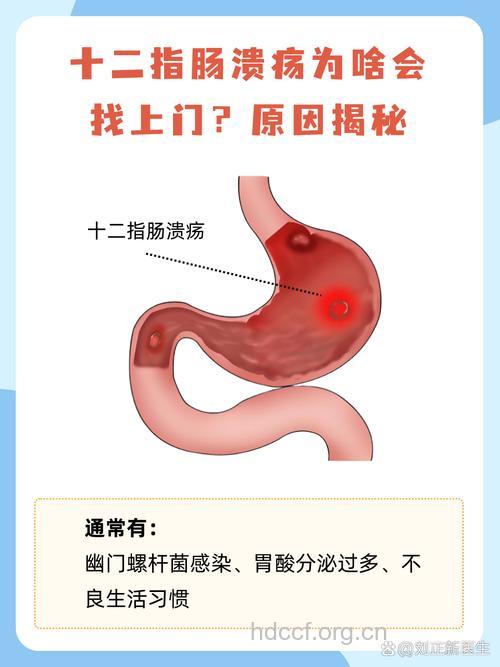 十二指肠溃疡的病因分析