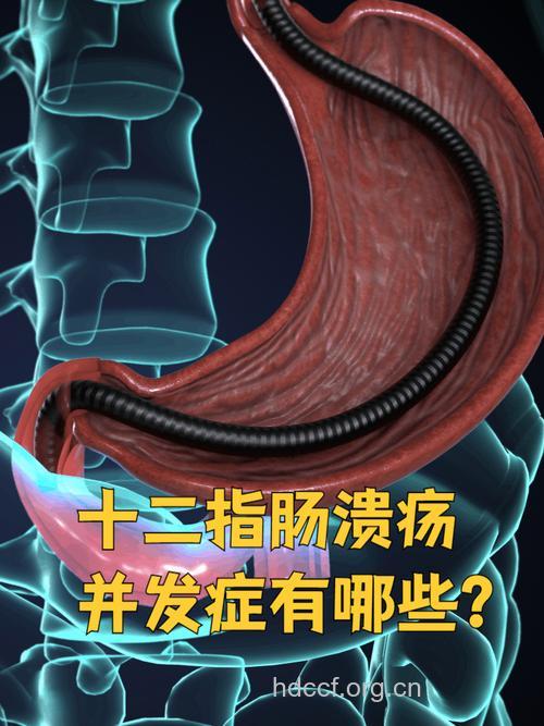 十二指肠溃疡哪些并发症