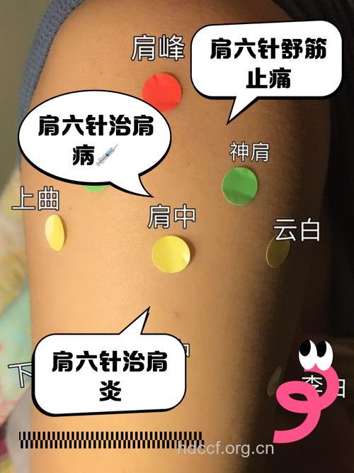 针灸在肩周炎上起到什么作用