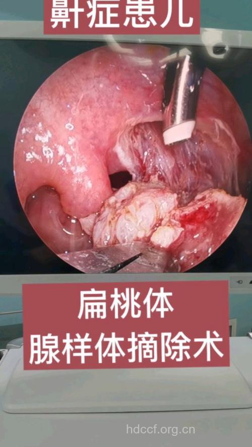 什么情况下扁桃体需要切除