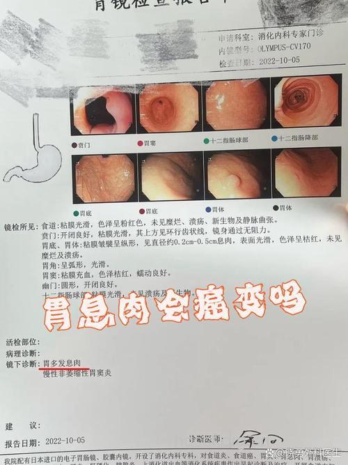 胃息肉会癌变吗 得了胃息肉怎么办