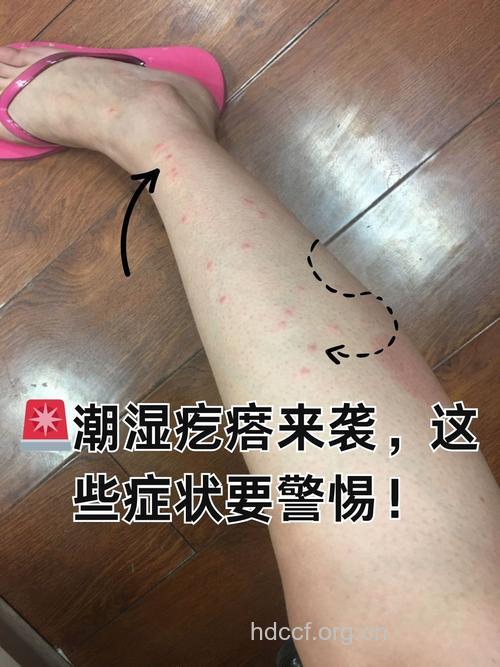 皮肤发痒 可能是因为体内湿气重